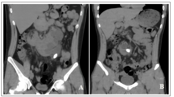 Fulltext | Combined Laparoscopic Pyelolithotomy with RIRS in a Patient ...