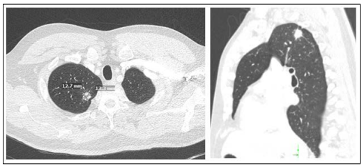 Fulltext | High-Grade Metastatic Pleomorphic Rhabdomyosarcoma in a TP53 ...