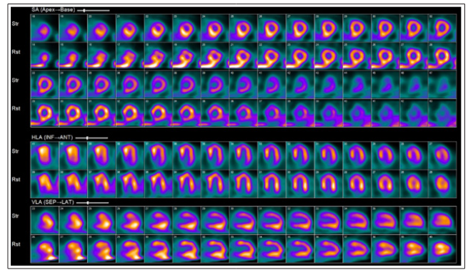 Fulltext | An Unusual Incidental Finding on a Myocardial Perfusion ...