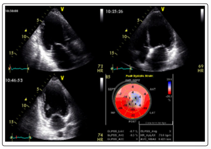 Clinical Applications of Strain Imaging in Aortic Valve Disease