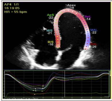 WHAT IS GLOBAL LONGITUDINAL STRAIN AND ITS CLINICAL IMPORTANCE? 