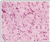 Fulltext | The Ropy Exuberance- Desmoplastic Fibroblastoma