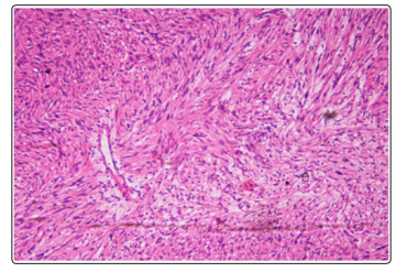 Fulltext | Schwannoma of Tibial Nerve; Diagnosis and Management: A Rare ...