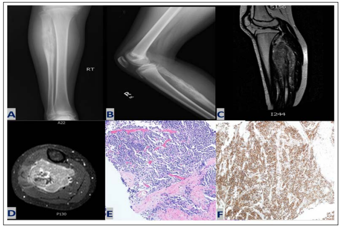 Fulltext | Peronea Magna Artery Challenging Proximal Fibula Resection ...