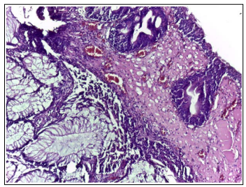 Fulltext | Pseudo Tumor of the Bladder Simulating Cancer: Pseudotumoral ...