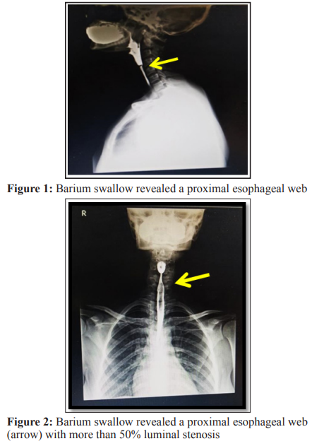 Fulltext | Plummer-Vinson Syndrome