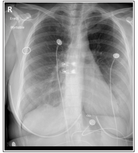 Fulltext | Recurrent Catamenial Pneumothorax After Multiple Chest Tube ...